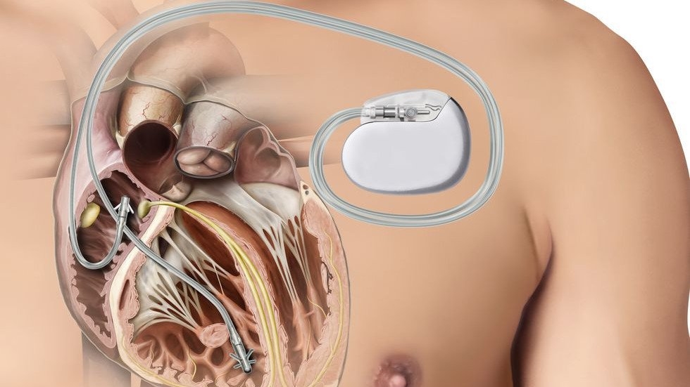 Что такое кардиостимулятор?