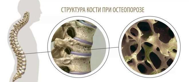 Как изменяется архитектоника кости при остеопорозе