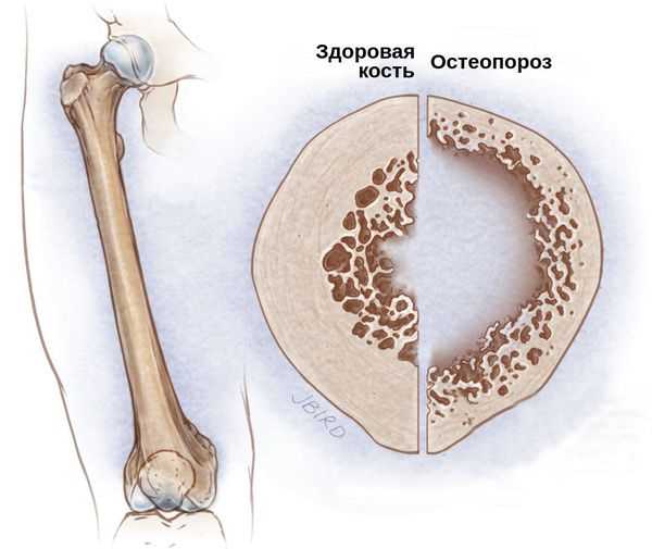 Изменение костей при остеопорозе 