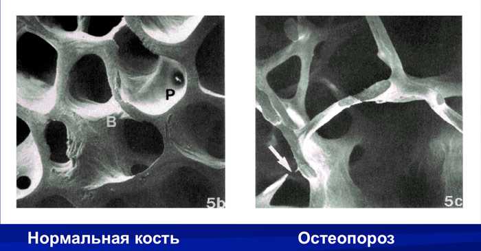 Изменение костей при остеопорозе 