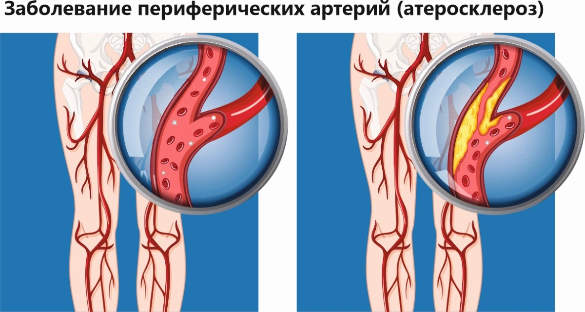 Особенности проявлений и лечения кровотечений из артерий