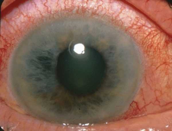 Острый приступ глаукомы симптомы причины лечение